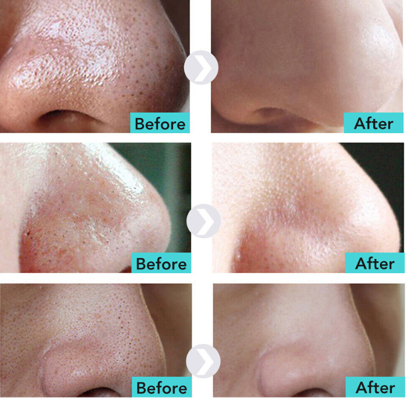 Labnena™ Pore Strips – Remove Blackheads in Just One Use