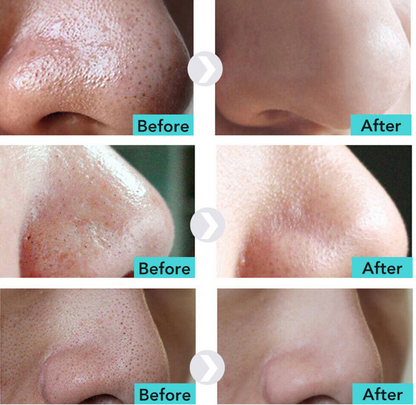 Labnena™ Pore Strips – Remove Blackheads in Just One Use